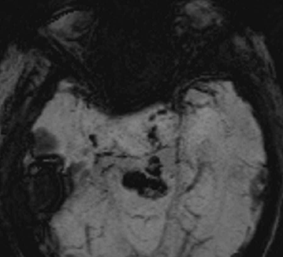 Pituitary Macroadenoma - CTisus CT Scan