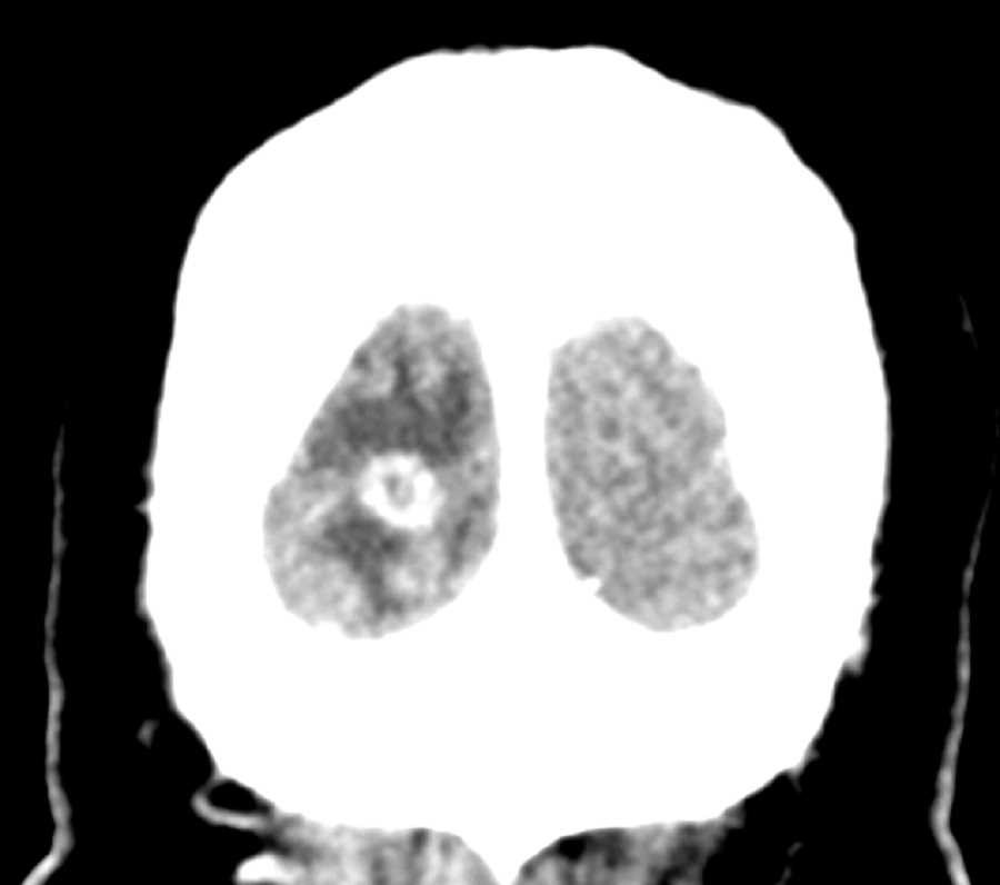 Intracranial Metastasis - CTisus CT Scan
