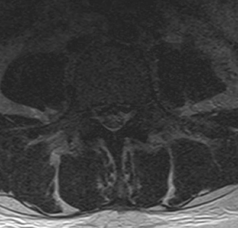 Dilated Epidural Venous Plexus - CTisus CT Scan
