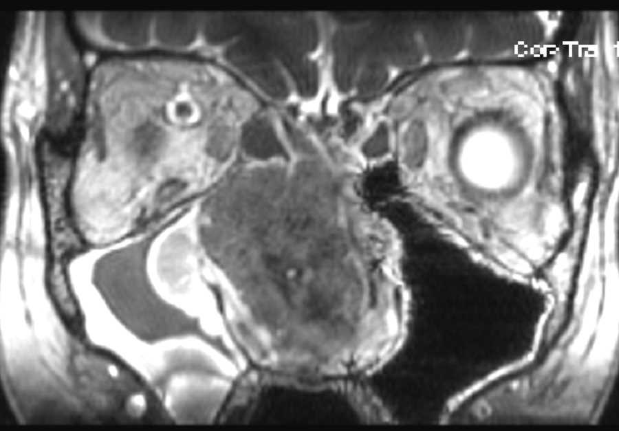 Nasal Squamous Cell Carcinoma - CTisus CT Scan