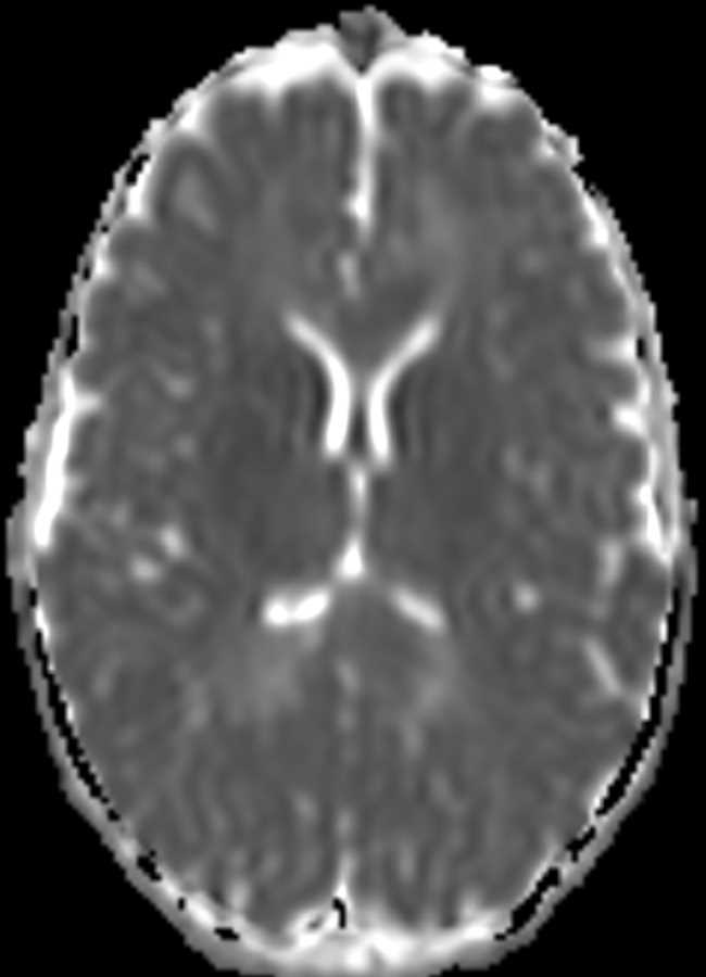 Neurofibromatosis Type 1 - CTisus CT Scan