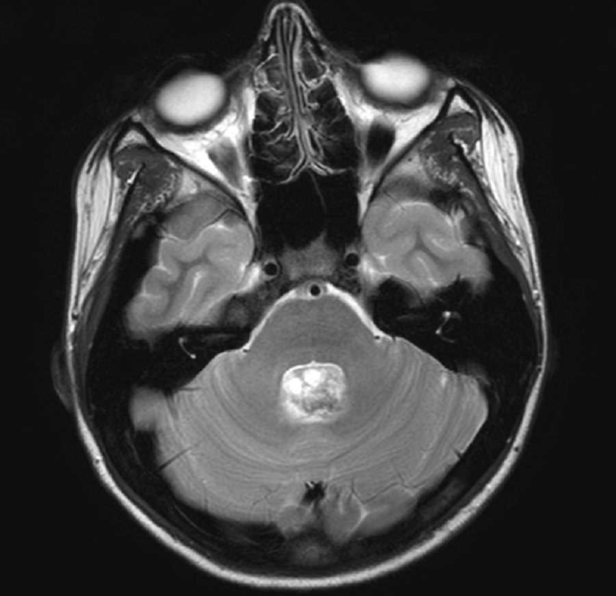 Ependymoma - CTisus CT Scan