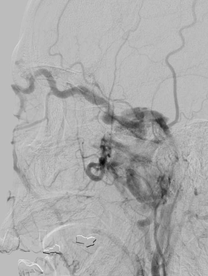 Carotid Cavernous Fistula - CTisus CT Scan