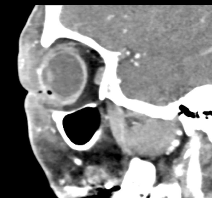 Periorbital Cellulitis - CTisus CT Scan