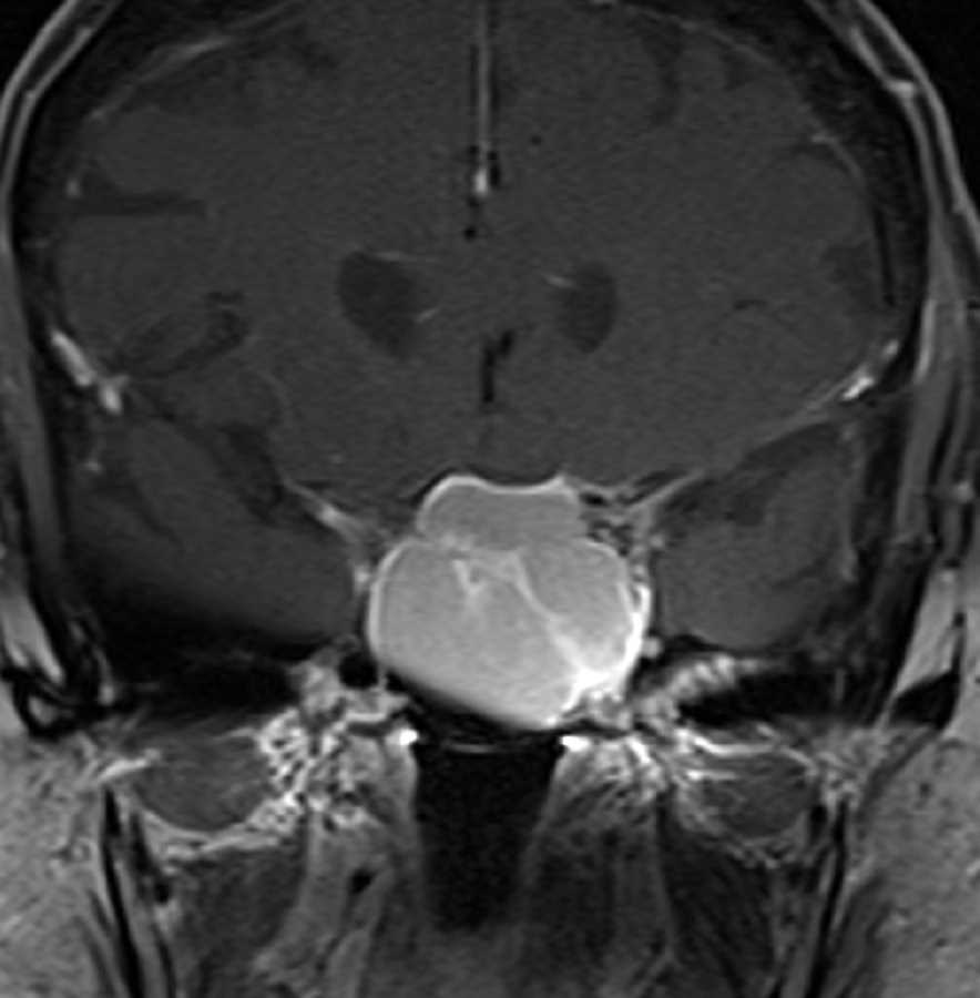 Sphenoid Mucocele - CTisus CT Scan