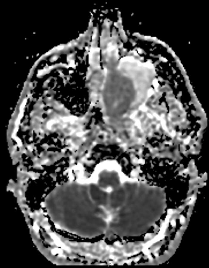 Inverted Papilloma - CTisus CT Scan