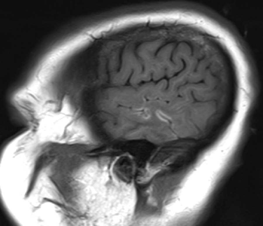 Neurosarcoidosis - CTisus CT Scan