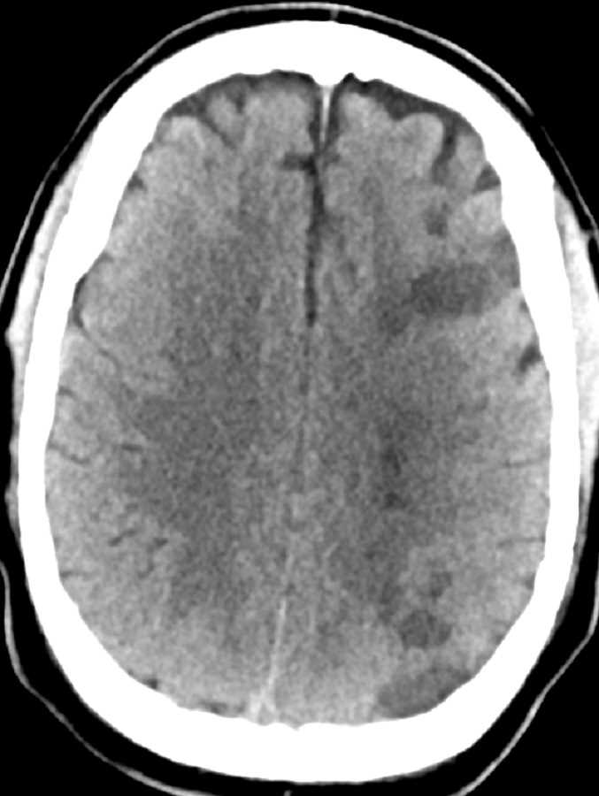 Watershed Infarcts - CTisus CT Scan