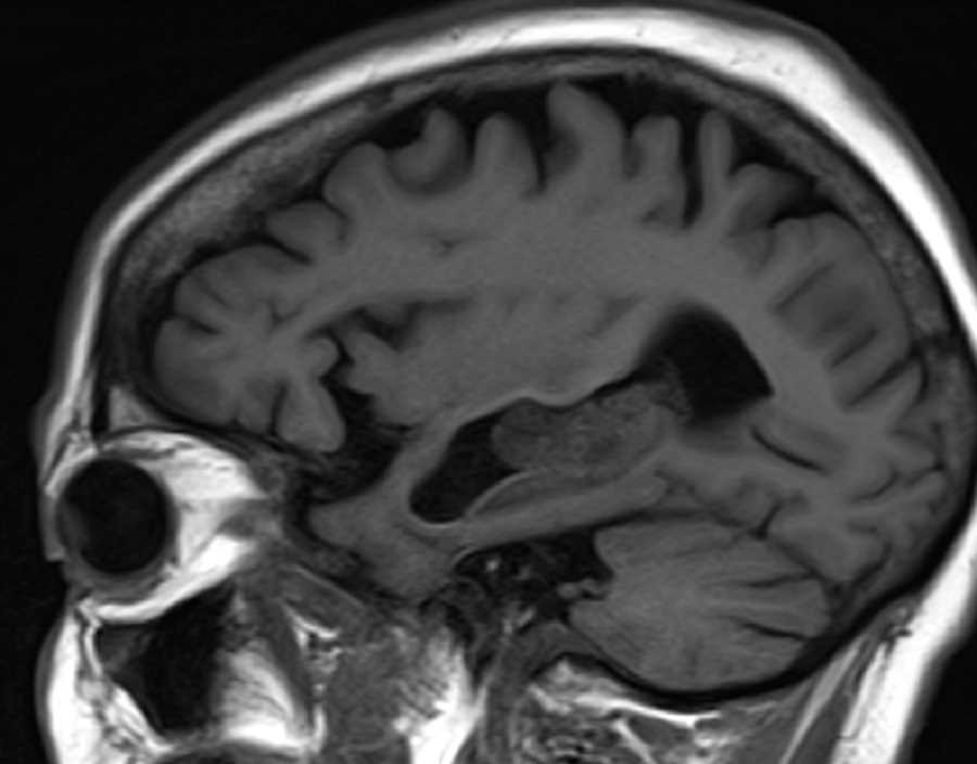 Intraventricular Metastasis - CTisus CT Scan