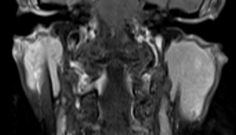 MALT Lymphoma - CTisus CT Scan