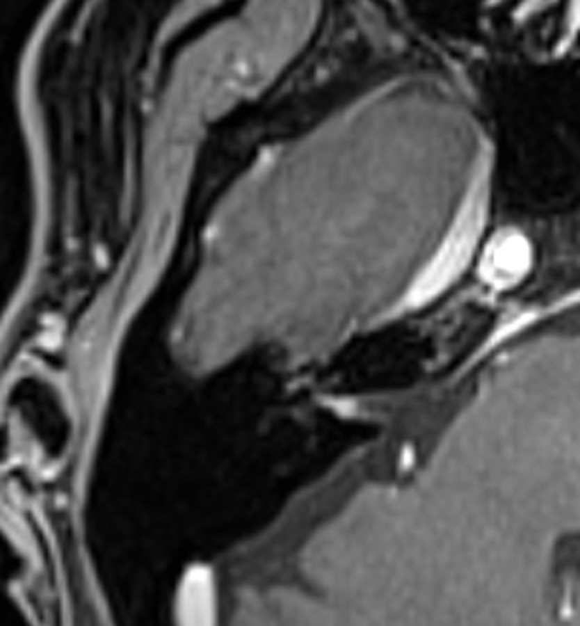 Lyme Disease - Neuro MR Case Studies - CTisus CT Scanning