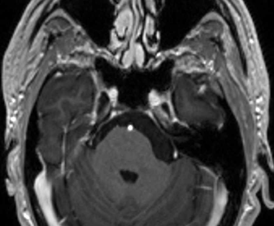 Epidermoid - CTisus CT Scan