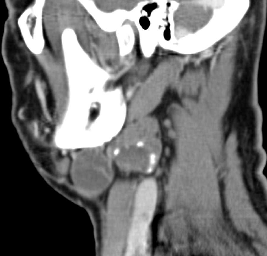 Tonsillar Squamous Cell Carcinoma - CTisus CT Scan