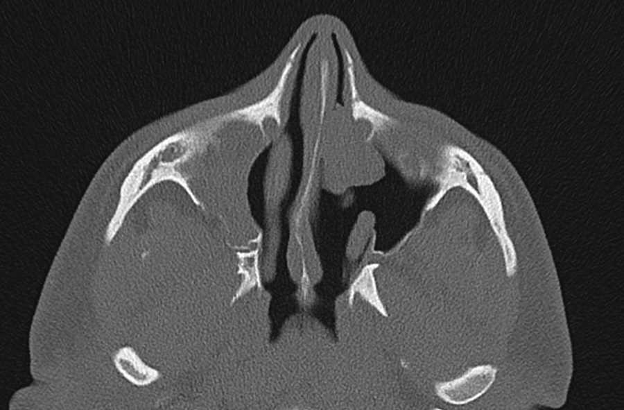 Uncinate Atelectasis - CTisus CT Scan