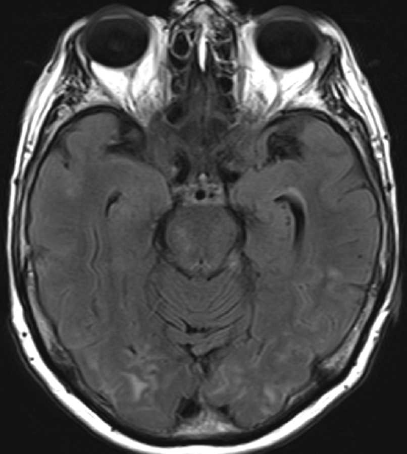 Amyloid Angiopathy - CTisus CT Scan