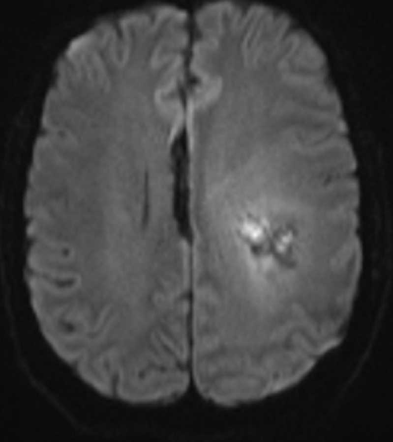 Pericallosal Lipoma - CTisus CT Scan