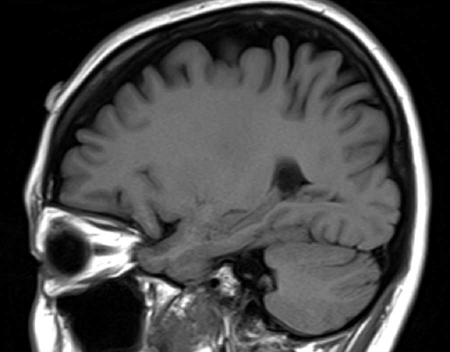 Choroid Plexus Xanthogranuloma - CTisus CT Scan