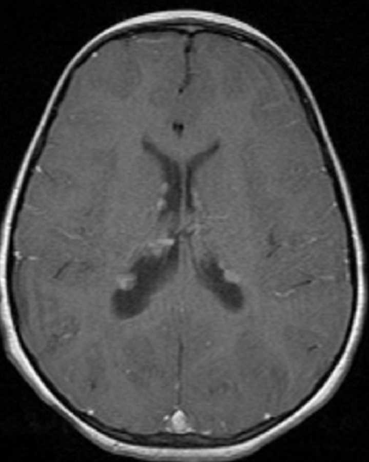 Tuberous Sclerosis - CTisus CT Scan