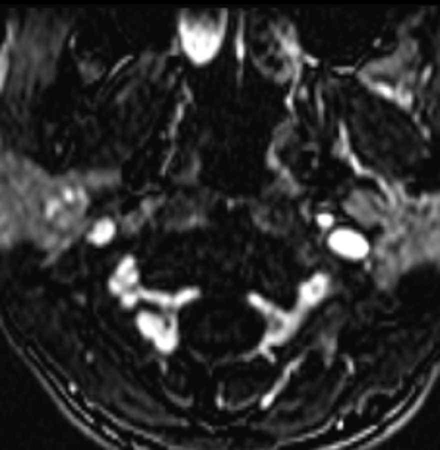 Internal Carotid Artery Dissection - CTisus CT Scan