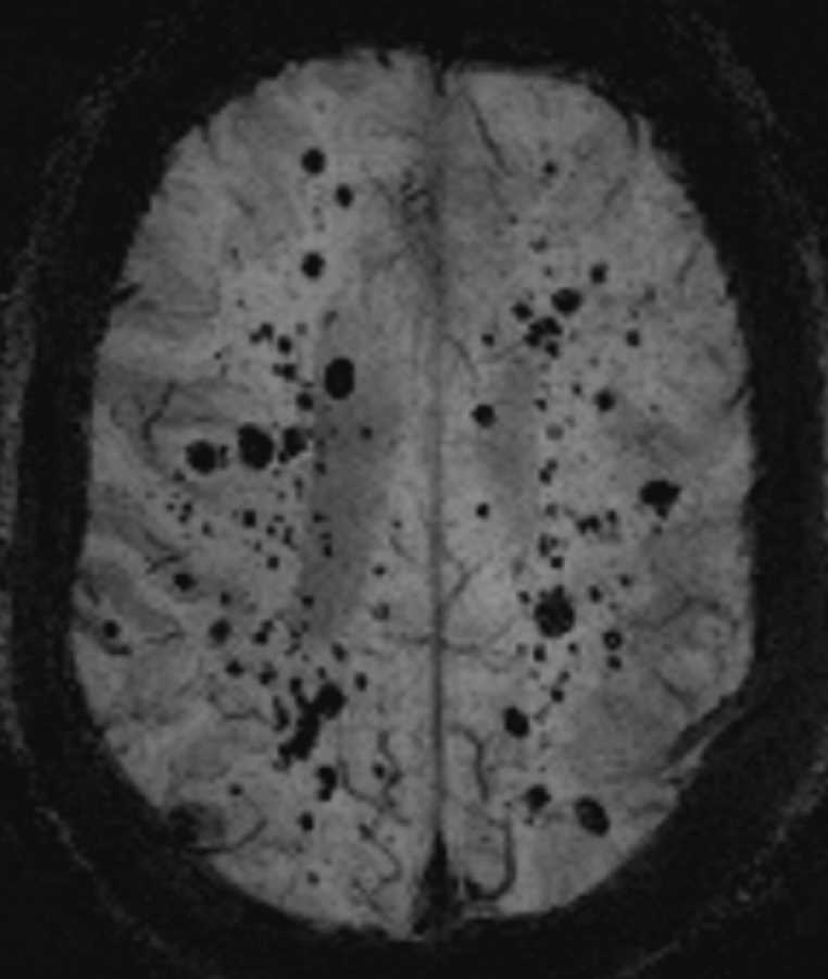 Multiple Cavernoma Syndrome - CTisus CT Scan