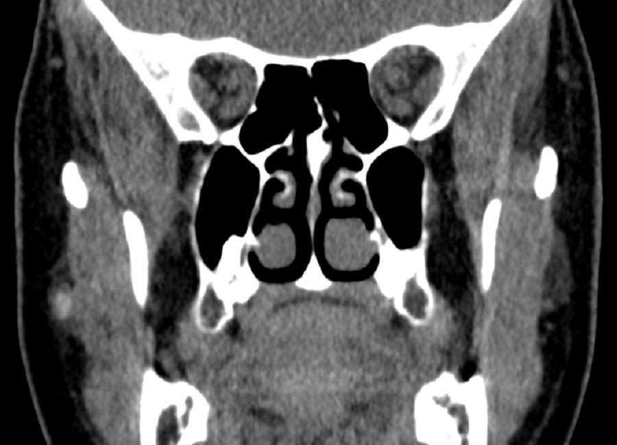Parotid Duct Stone - CTisus CT Scan