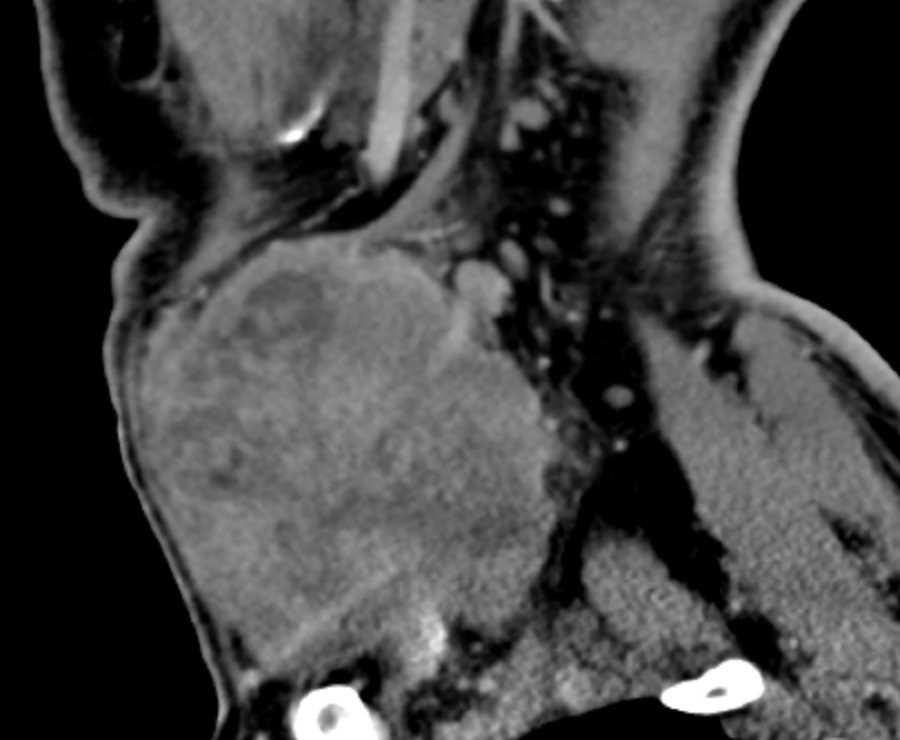 Anaplastic Thyroid Cancer - CTisus CT Scan