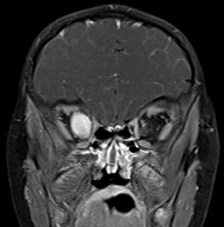 Optic Nerve Glioma - CTisus CT Scan