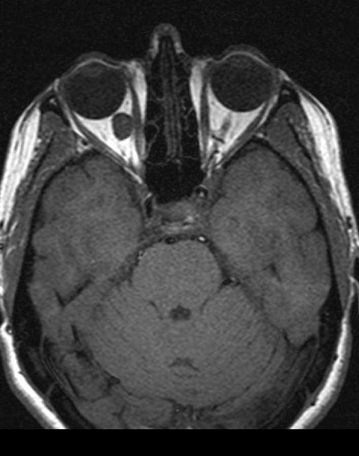Orbital Hemangioma - CTisus CT Scan