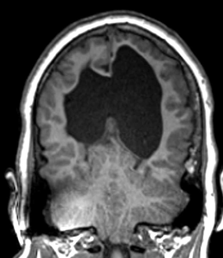 Chiari II Malformation - CTisus CT Scan
