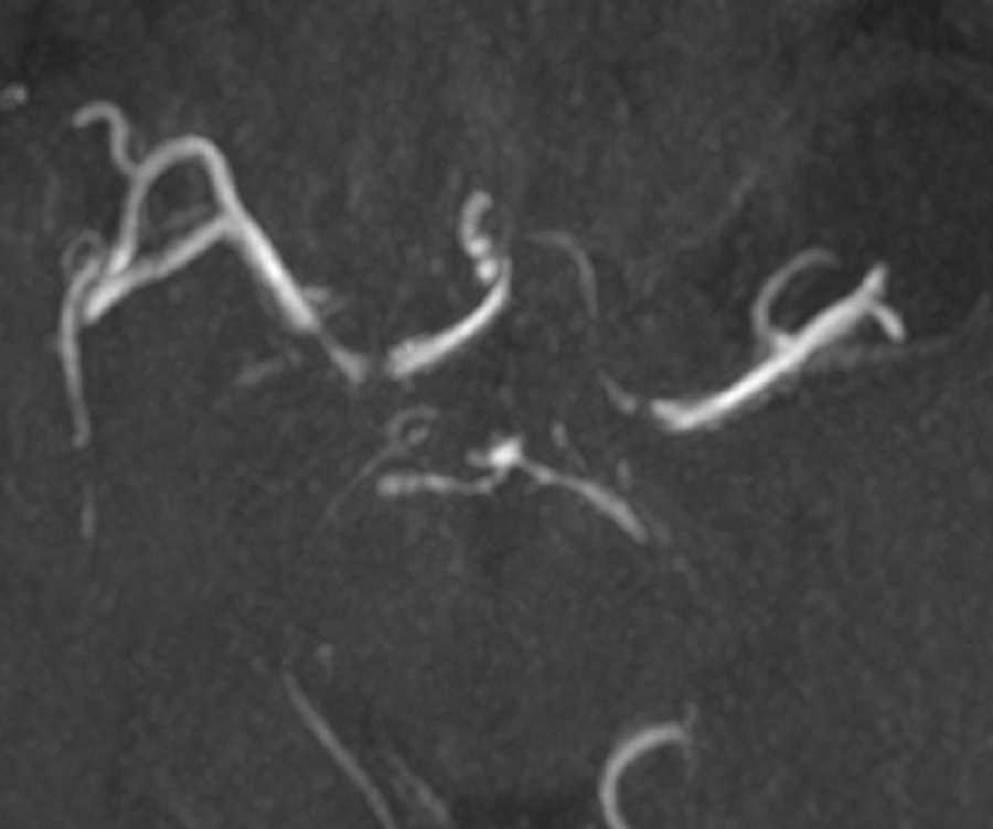 Intracranial Vasospasm - CTisus CT Scan