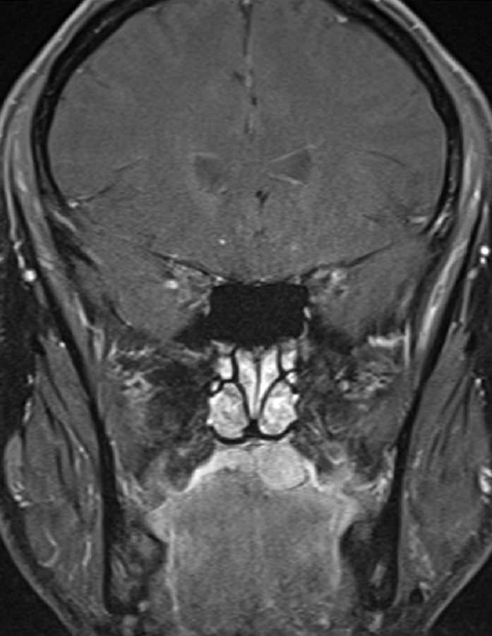 Palatal Basal Cell Carcinoma - CTisus CT Scan