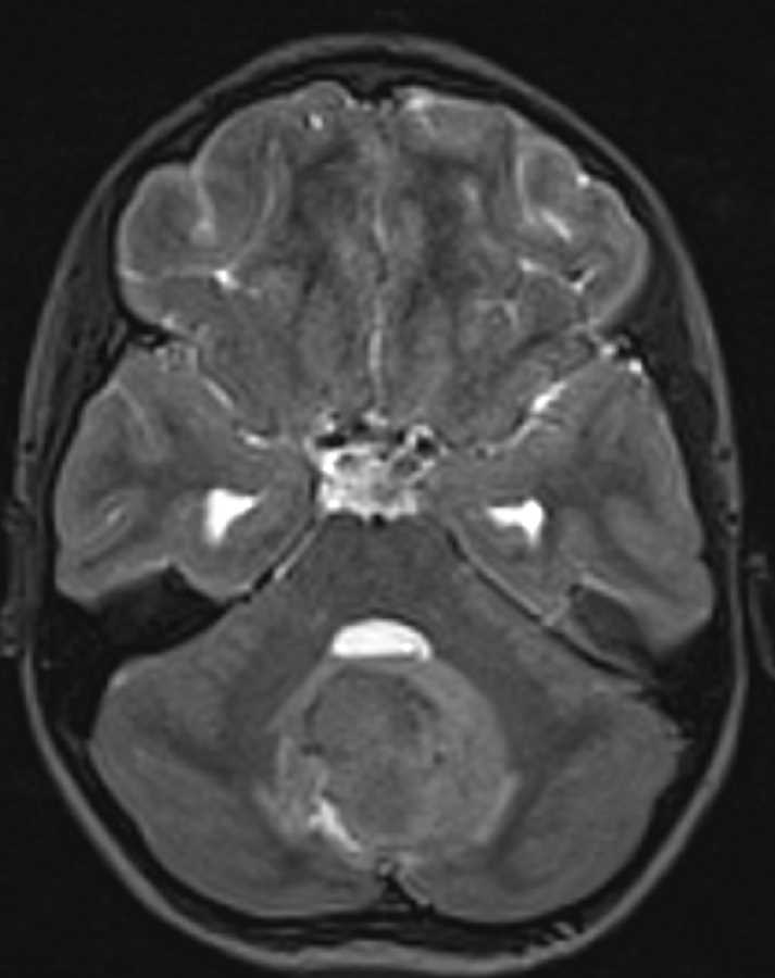 Medulloblastoma - CTisus CT Scan