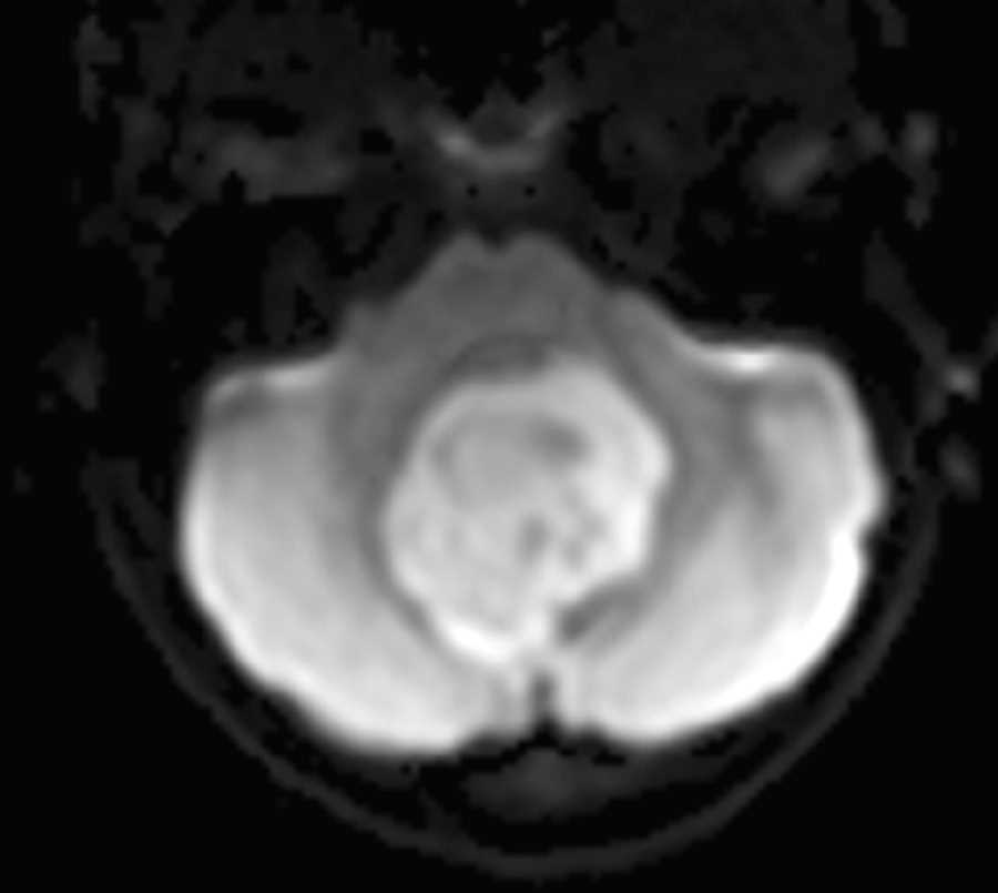 Medulloblastoma - Neuro MR Case Studies - CTisus CT Scanning