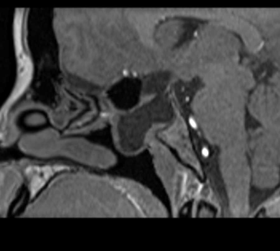 Meningoencephalocele - CTisus CT Scan