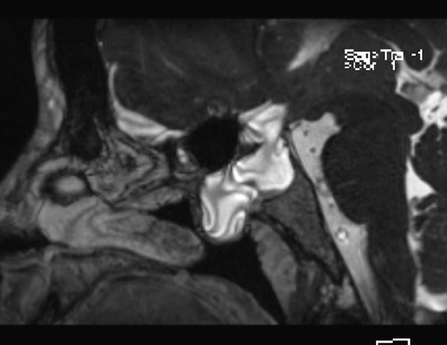 Meningoencephalocele - CTisus CT Scan