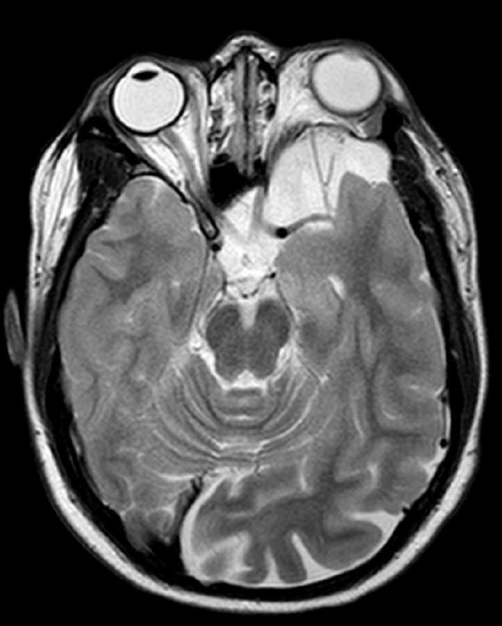 Sphenoid Wing Dysplasia - CTisus CT Scan