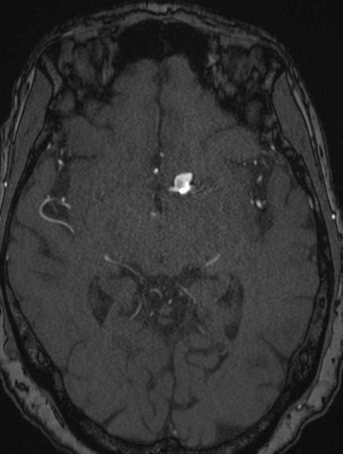 Intracranial Aneurysm - CTisus CT Scan