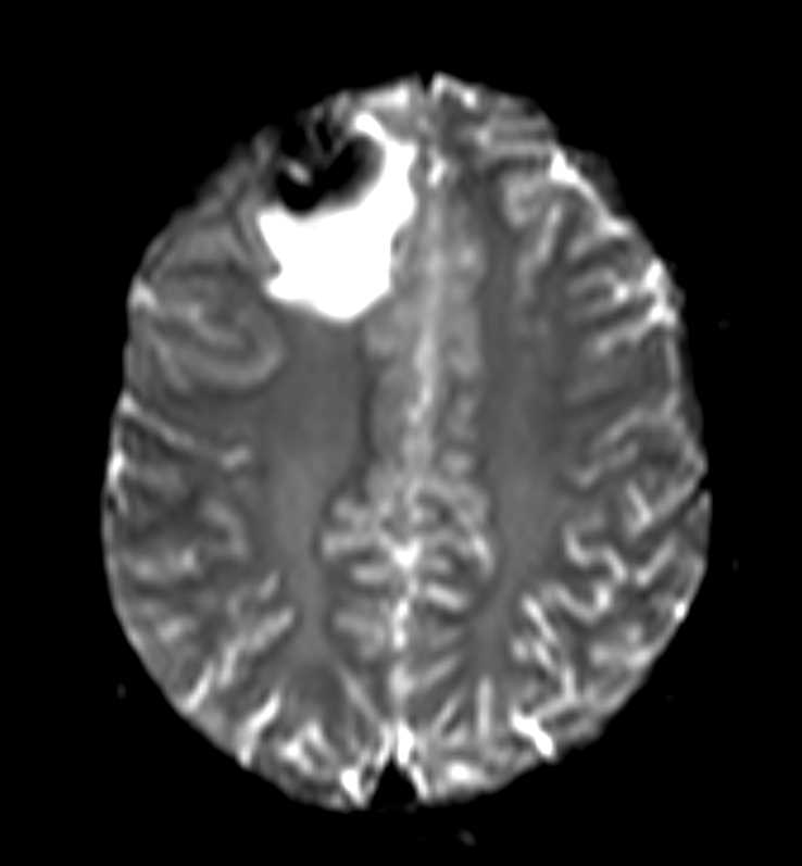 Primary Glioma - CTisus CT Scan