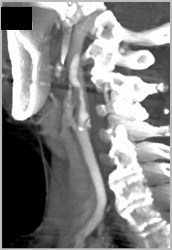 Carotid Bifurcation Without Stenosis But With Plaque - CTisus CT Scan