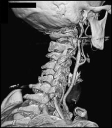 Normal Carotid Bifurcation - CTisus CT Scan