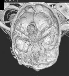 Normal Basilar Artery - CTisus CT Scan