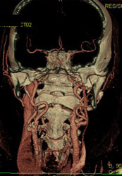 Normal Carotid Artery - CTisus CT Scan