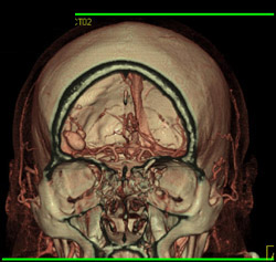 Middle Cerebral Artery Aneurysm - CTisus CT Scan