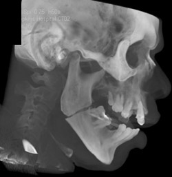 Mandibular Fractures - CTisus CT Scan