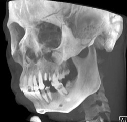 Frontal Bone Fracture - CTisus CT Scan