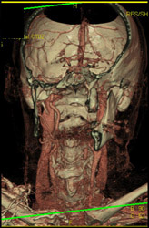 CTA of Normal Carotid Artery - CTisus CT Scan