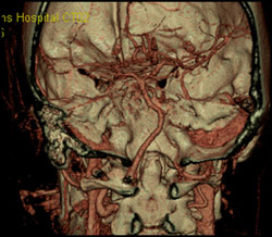 Normal Circle of Willis (COW) - CTisus CT Scan