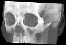 Orbital Fracture - CTisus CT Scan