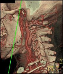 Normal Carotid Artery - CTisus CT Scan