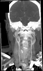 Normal Carotid Artery - CTisus CT Scan